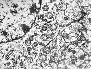 F,24y. | gangliocytoma